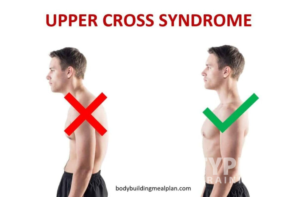 Upper Cross Syndrome
