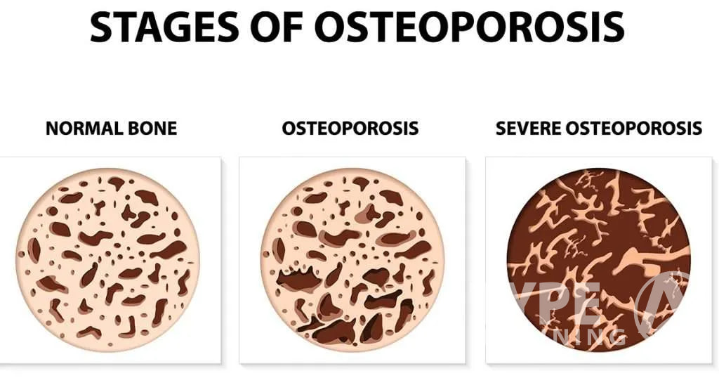Protein and Bone Health