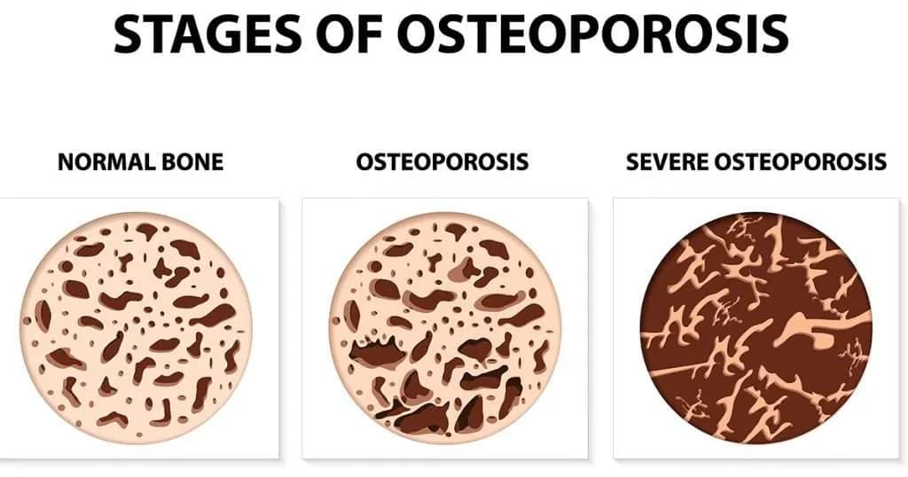 Protein and Bone Health