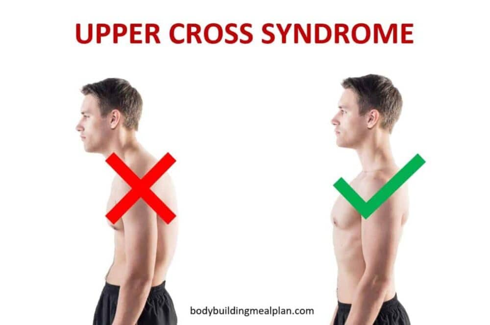 Upper Cross Syndrome